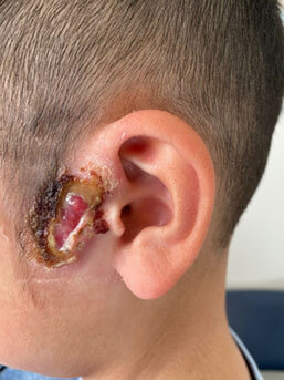 preauricular pit infection